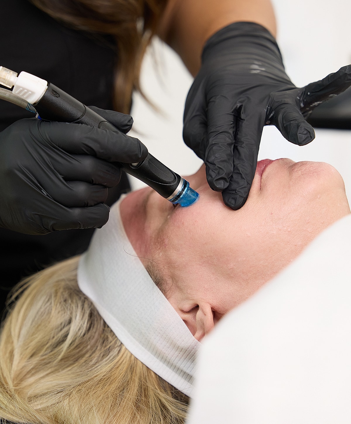 Microneedling treatment session in progress.